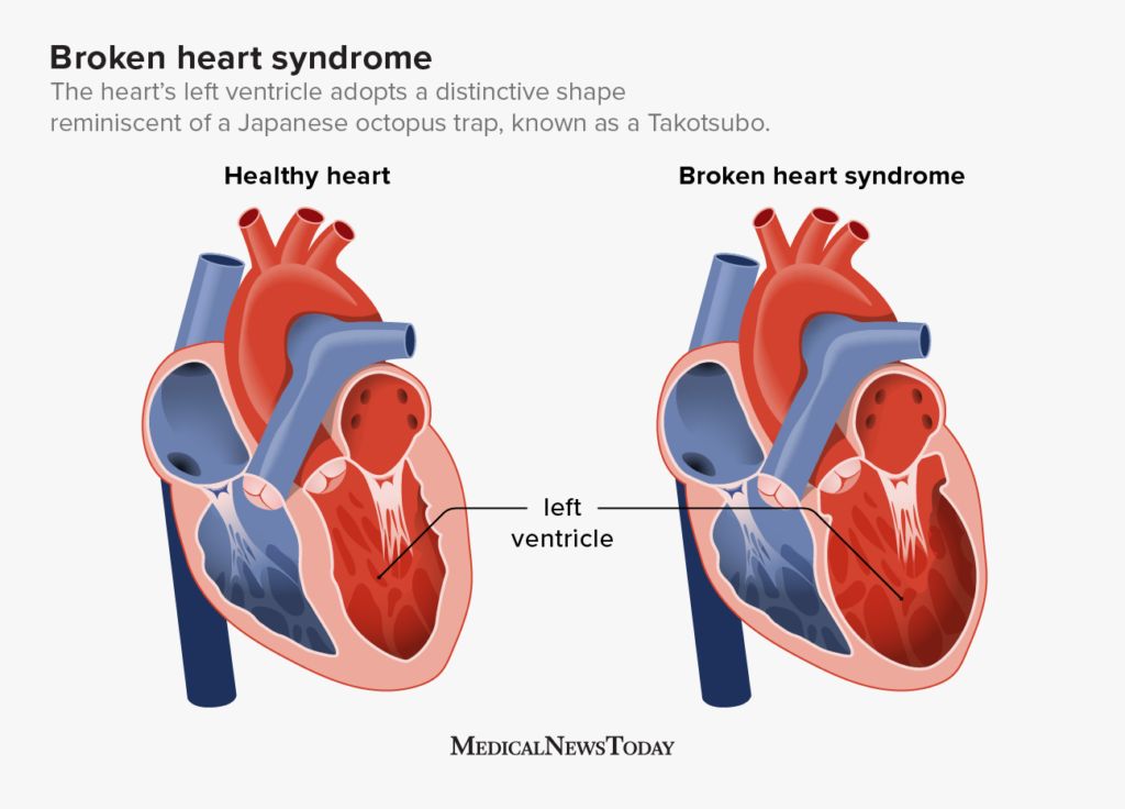 Broken heart syndrome infographic displaying differences between the left ventricle