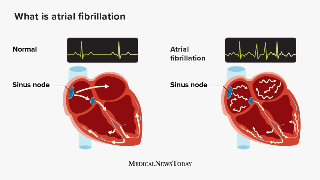 A diagram detailing what is atrial fibrillation 